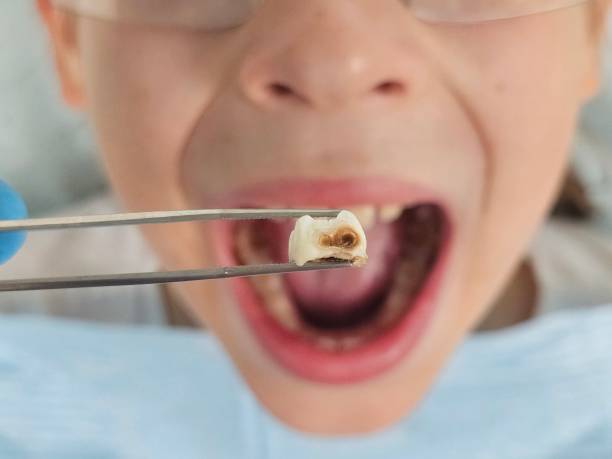 Best Broken or Chipped Tooth Repair in USA